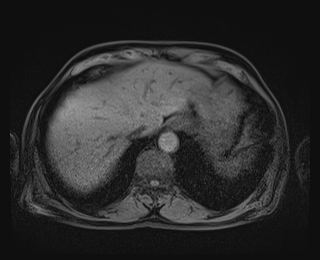 Bouveret syndrome (Radiopaedia 61017-68856 Axial T1 fat sat 12).jpg