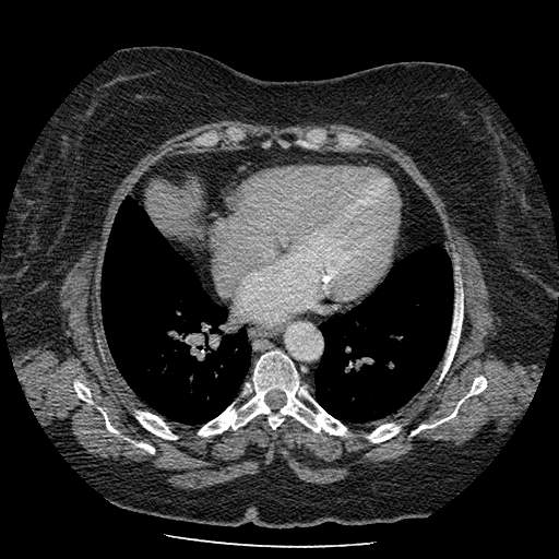 Bovine aortic arch - right internal mammary vein drains into the superior vena cava (Radiopaedia 63296-71875 A 102).jpg