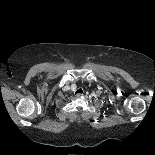 Bovine aortic arch - right internal mammary vein drains into the superior vena cava (Radiopaedia 63296-71875 A 8).jpg