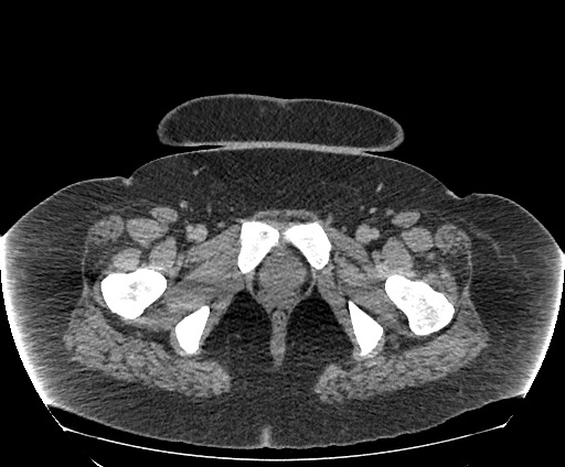 Bowel and splenic infarcts in acute lymphocytic leukemia (Radiopaedia 61055-68913 A 125).jpg