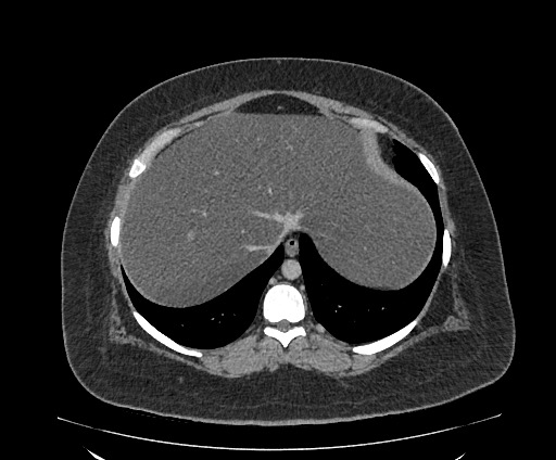 File:Bowel and splenic infarcts in acute lymphocytic leukemia (Radiopaedia 61055-68913 A 24).jpg