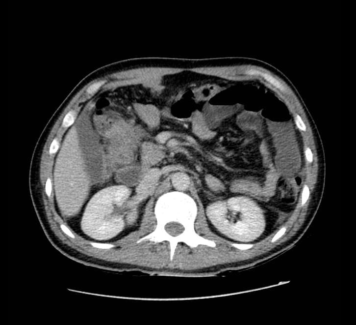 Bowel obstruction from colon carcinoma (Radiopaedia 22995-23028 A 29).jpg