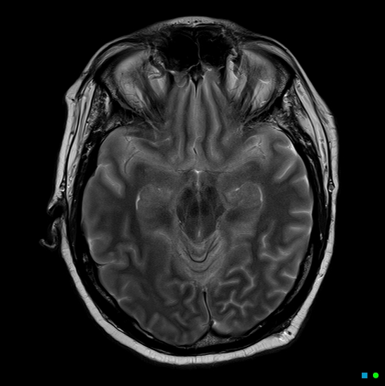 File:Brain death on MRI and CT angiography (Radiopaedia 42560-45689 Axial T2 14).jpg