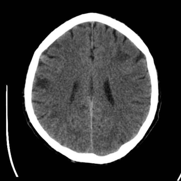 Brain metastases from lung cancer (Radiopaedia 24480-24781 Axial non-contrast 32).jpg