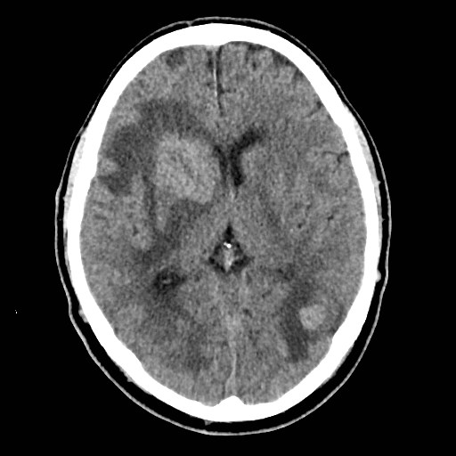 File:Brain metastases from lung cancer (Radiopaedia 83839-99027 Axial non-contrast 18).jpg