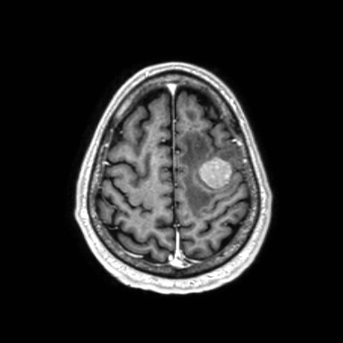 Brain metastases from lung cancer (Radiopaedia 83839-99028 Axial T1 C+ 56).jpg