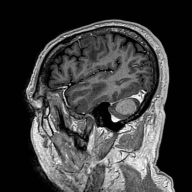 Brain metastases from lung cancer (Radiopaedia 83839-99028 Sagittal T1 C+ 53).jpg