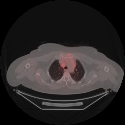 Brain metastasis (Radiopaedia 89847-106962 Axial lung window 10).jpg
