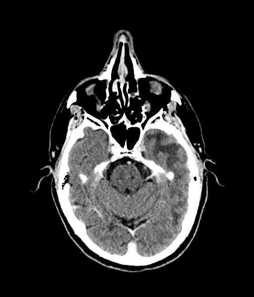 Brain metastasis (large cystic mass) (Radiopaedia 47497-52106 Axial C+ 23).png