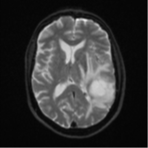 File:Brain metastasis (large cystic mass) (Radiopaedia 47497-52107 Axial DWI 15).png