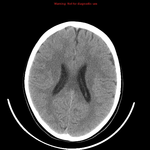 File:Brainstem glioma (Radiopaedia 9444-10123 non-contrast 15).jpg