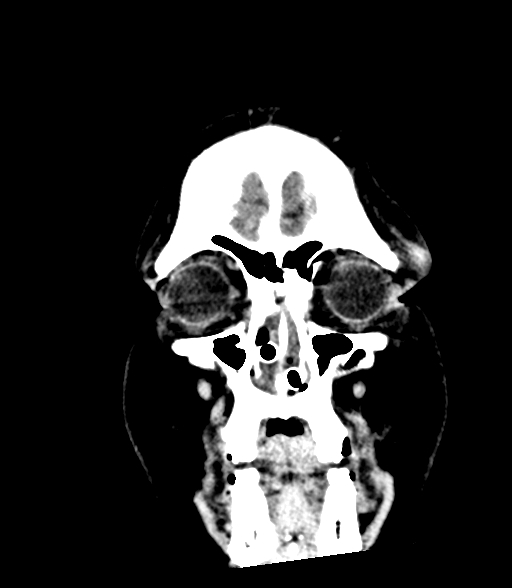 Brainstem hemorrhage (Radiopaedia 81294-94976 Coronal non-contrast 7).jpg