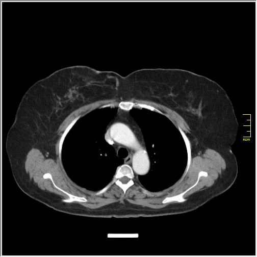 File:Breast cancer on thorax CT (Radiopaedia 60571-68275 A 31).JPG
