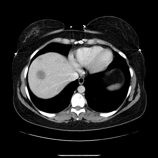 File:Breast cancer pseudocirrhosis after chemotherapy (Radiopaedia 65407-74456 A 12).jpg