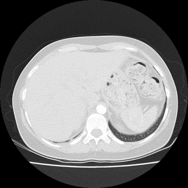 Bronchial atresia (Radiopaedia 22965-22992 Axial lung window 7).jpg