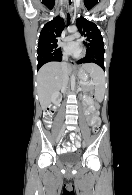 Bronchial carcinoid tumor (Radiopaedia 57187-64090 B 48).jpg