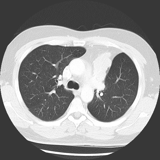 Bronchial carcinoid tumor (Radiopaedia 67377-76764 Axial lung window 25).jpg