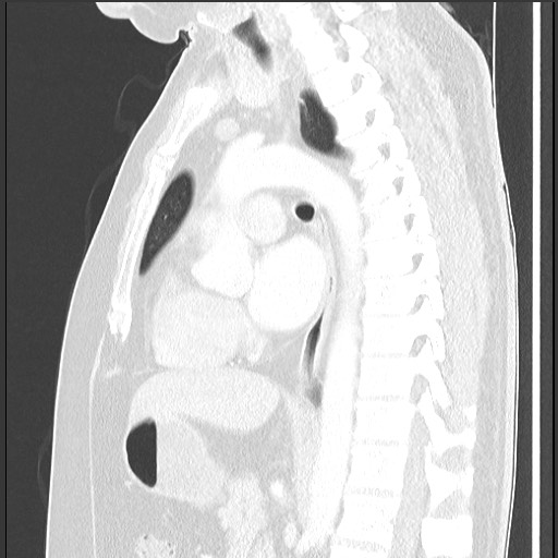 File:Bronchial carcinoid tumor (Radiopaedia 67377-76764 Sagittal lung window 37).jpg