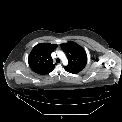 Bronchial carcinoid tumor (Radiopaedia 78272-90870 B 40).jpg