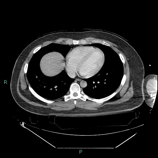 Bronchial carcinoid tumor (Radiopaedia 78272-90870 C 81).jpg
