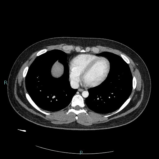 File:Bronchial carcinoid tumor (Radiopaedia 78272-90875 A 68).jpg