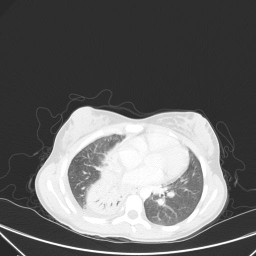 Bronchial mucoepidermoid carcinoma (Radiopaedia 57023-63895 Axial lung window 64).jpg