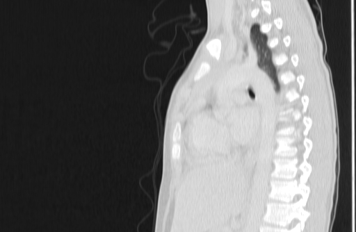 Bronchial mucoepidermoid carcinoma (Radiopaedia 57023-63895 Sagittal lung window 98).jpg