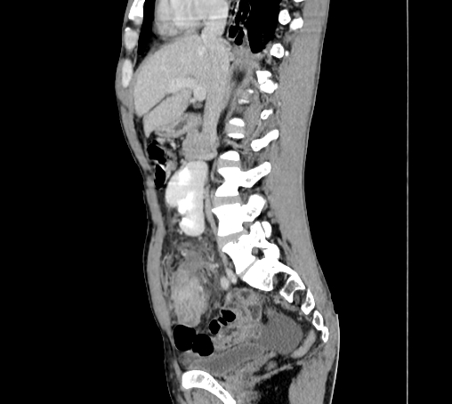 File:Bronchiectasis in Crohn disease (Radiopaedia 60311-67977 D 46).jpg