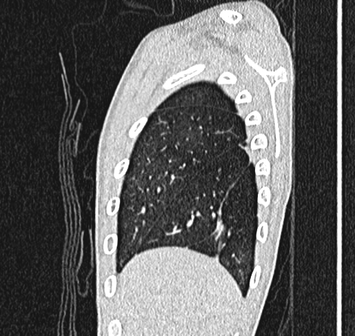 Bronchiolitis obliterans (Radiopaedia 71538-81897 Sagittal lung window 7).jpg