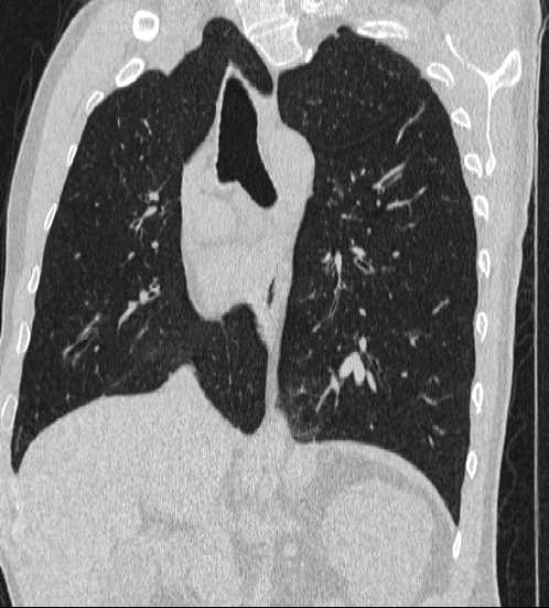 File:Bronchocele (Radiopaedia 60676-68429 Oblique lung window 19).jpg