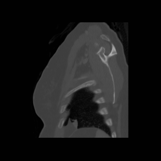 File:Bronchogenic carcinoma (Radiopaedia 73497-84262 Sagittal bone window 134).jpg