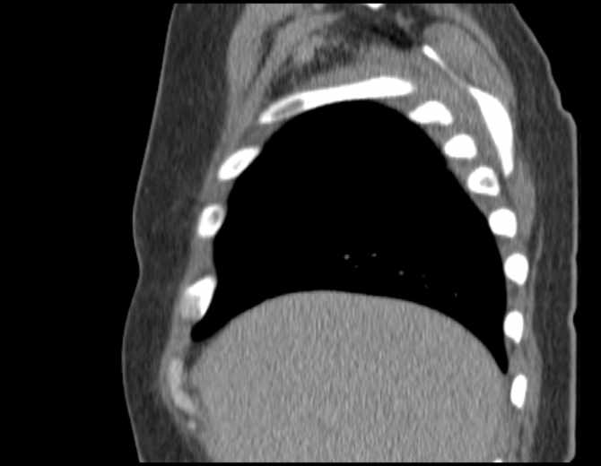 Brown tumors compressing the spinal cord (Radiopaedia 68442-77988 B 14).jpg