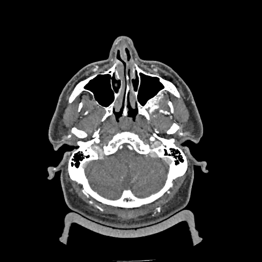 Buccal fat pad arteriovenous malformation (Radiopaedia 70936-81144 D 240).jpg