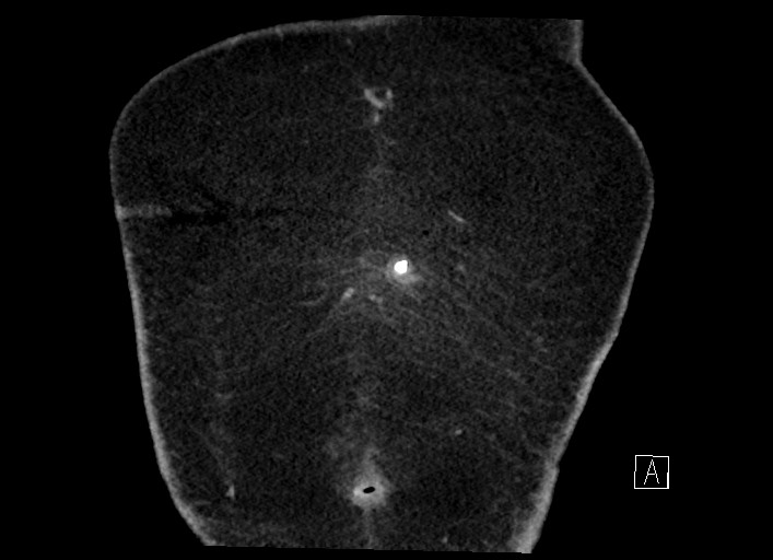 Buried bumper syndrome - gastrostomy tube (Radiopaedia 63843-72577 Coronal Inject 5).jpg
