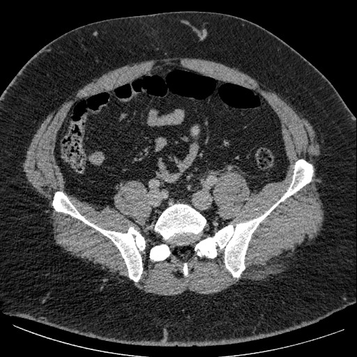 Burned-out testicular seminoma - retroperitoneal nodal metastases (Radiopaedia 62872-71245 A 53).jpg