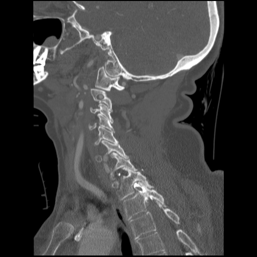 File:C1 anterior arch (plough) fracture - type 1 (Radiopaedia 76181-87720 Sagittal bone window 43).jpg