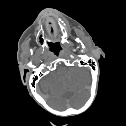 File:C2 fracture with vertebral artery dissection (Radiopaedia 37378-39200 A 199).png