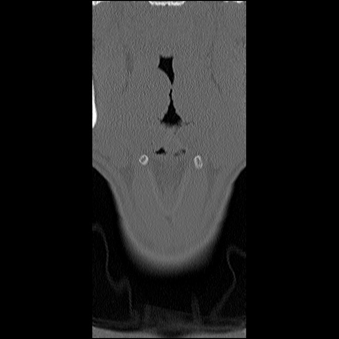 C5 facet fracture (Radiopaedia 58374-65499 Coronal bone window 7).jpg