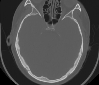C7 laminar fracture and Klippel-Feil syndrome (Radiopaedia 86710-102850 Axial bone window 5).jpg