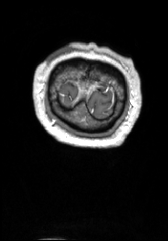 CNS cryptococcosis (Radiopaedia 70895-81108 Coronal T1 C+ 186).jpg