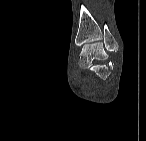 Calcaneal fracture - Sanders type 4 (Radiopaedia 90179-107370 Coronal bone window 64).jpg