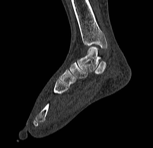 Calcaneal fracture - Sanders type 4 (Radiopaedia 90179-107370 Sagittal bone window 40).jpg