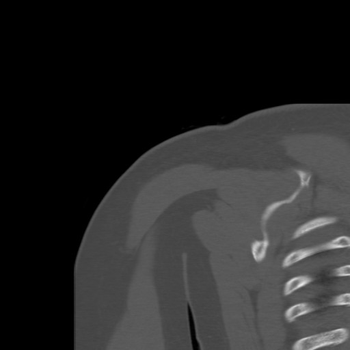 File:Calcific tendinitis of the infraspinatus tendon (Radiopaedia 87256-103539 Coronal bone window 47).jpg