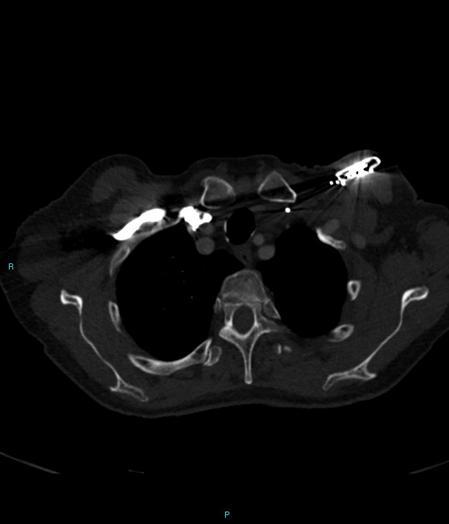 Calcified cerebral emboli from left ventricular thrombus (Radiopaedia 84420-99760 Axial bone window 11).jpg