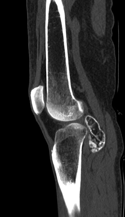 Calcified hematoma - popliteal fossa (Radiopaedia 63938-72763 Sagittal bone window 74).jpg
