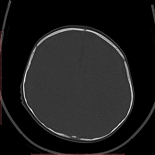 Calcified middle cerebral artery embolism (Radiopaedia 78949-91860 Axial bone window 48).jpg