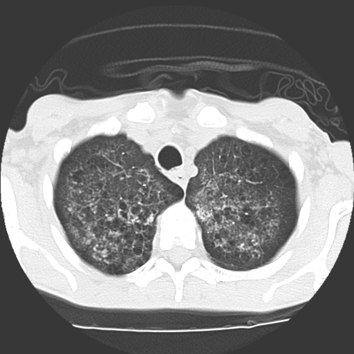 File:Calciphylaxis and metastatic pulmonary calcification (Radiopaedia 10887-11317 Axial lung window 4).jpg
