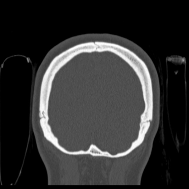 Calvarial osteoma (Radiopaedia 36520-38079 C 82).jpg