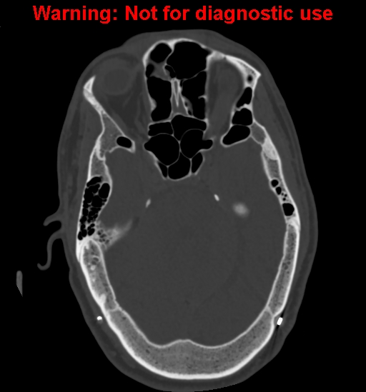 Calvarial thickening from chronic shunting (Radiopaedia 60079-67637 Axial bone window 62).jpg