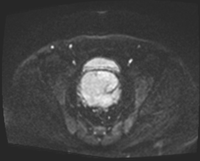 Cancer cervix - stage IIb (Radiopaedia 75411-86615 Axial DWI 44).jpg